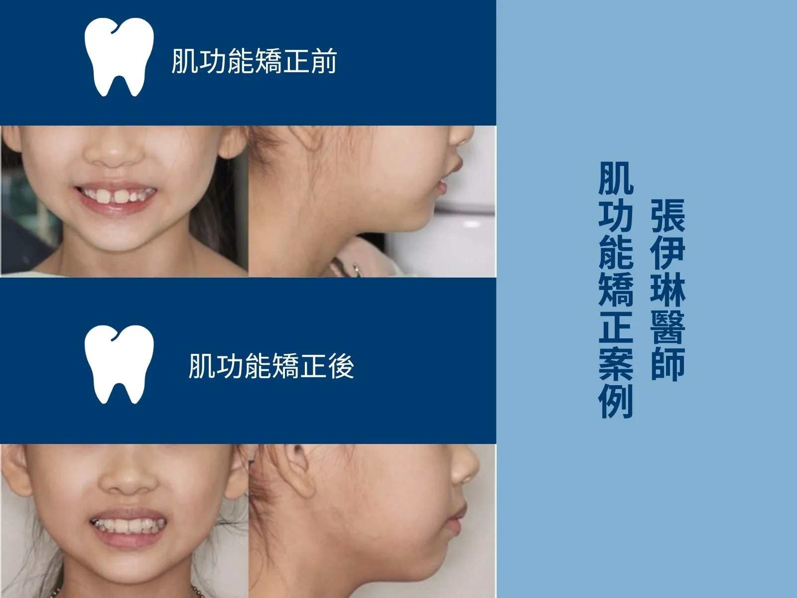 同一位孩子肌功能矯正前後對照：上排為矯正前、下排為矯正後，各有一張正面微笑（可看到前牙）與一張側面輪廓照片
